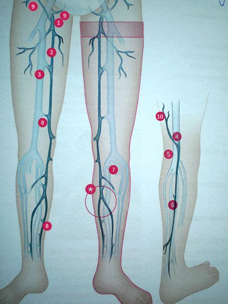 ce sunt varicele simptomelor picioarelor
